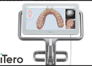「iTero（アイテロ）」導入 歯型取り1回＆通院回数の少ない矯正治療